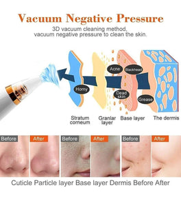 SHAMFY BLACKHEAD REMOVER