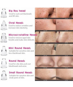 SHAMFY BLACKHEAD REMOVER